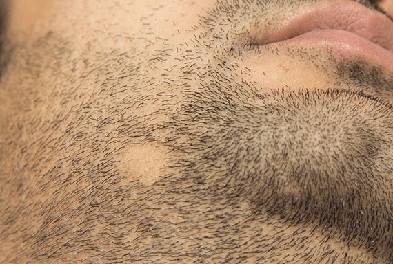 Pelade de la barbe