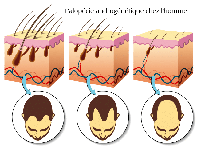 Alopécie androgénétique chez l'homme