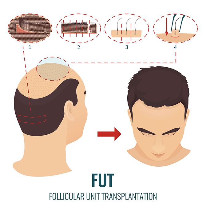 Greffe de cheveux avec la technique FUT (Follicular Unit Transplantation)